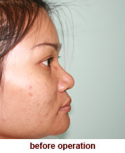 plastic_surgery_augmentation_rhinoplasty